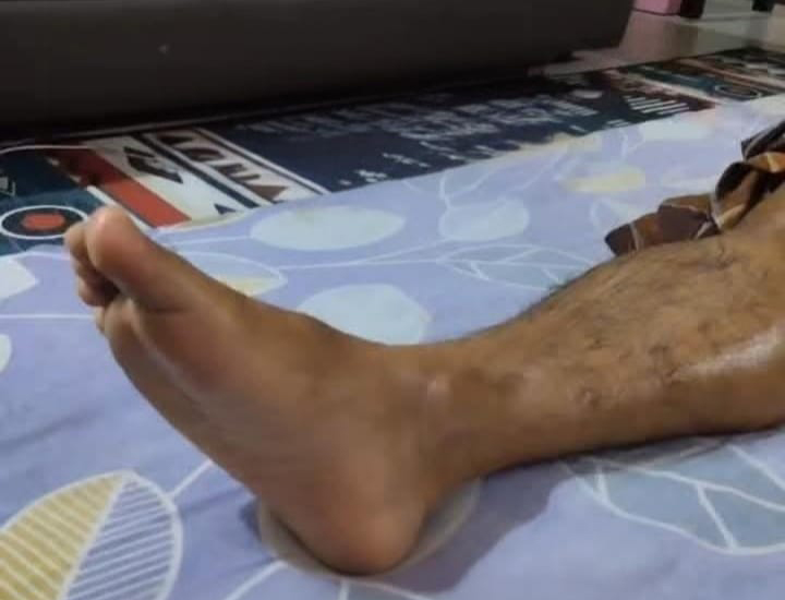 Paralysis Massage